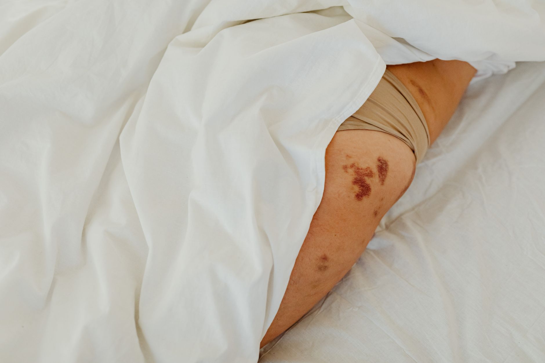Punaises de lit dans l'Orne : quels dangers pour la santé des enfants ?